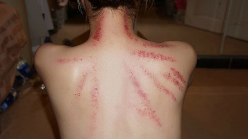 các vị trí cạo gió