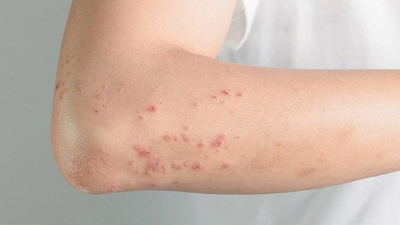 Người bị mề đay, mẩn ngứa