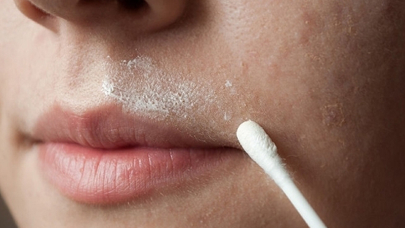 Tẩy lông mép bằng oxy già