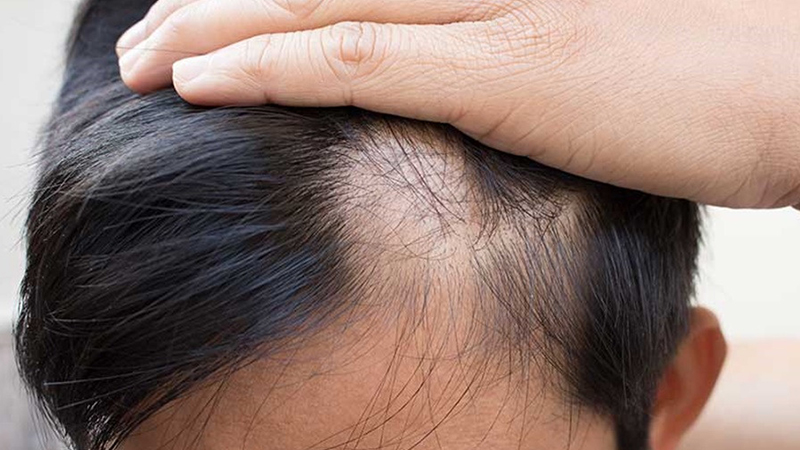 Sao Việt và doanh nhân bật mí cách trị hói đầu, rụng tóc - VnExpress Sức  khỏe